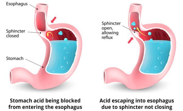 How To Stop Acid Reflux From Stealing Your Voice | Singer's Guide ...